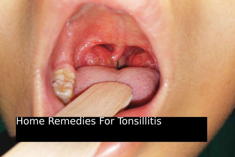 Home Remedies For Tonsillitis