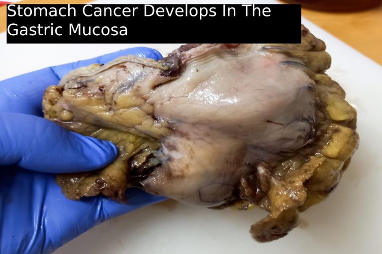 Stomach Cancer Develops In The Gastric Mucosa