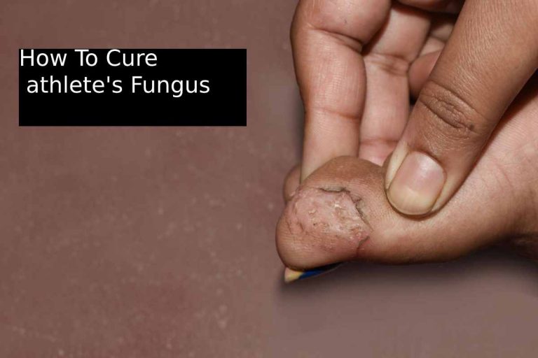 How To Cure  athlete's Fungus