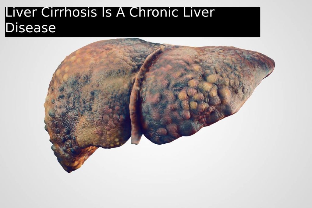 Liver Cirrhosis Is A Chronic Liver Disease
